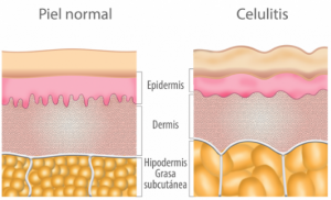 tratamiento celulitis pamplona